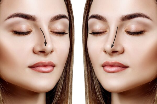 Rinoplastia o abordare personalizată cu Dr. Bortolini la Clinica BePerfect din București